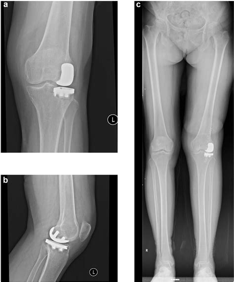 Figure From A Case Of Subchondral Insufficiency Fracture Of The Knee