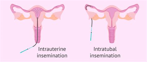 What Are Antisperm Antibodies? - Causes & Treatment