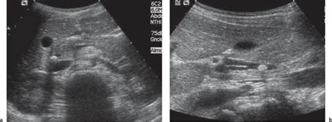 Liver Portal Venous System And Hepatic Veins Radiology Key