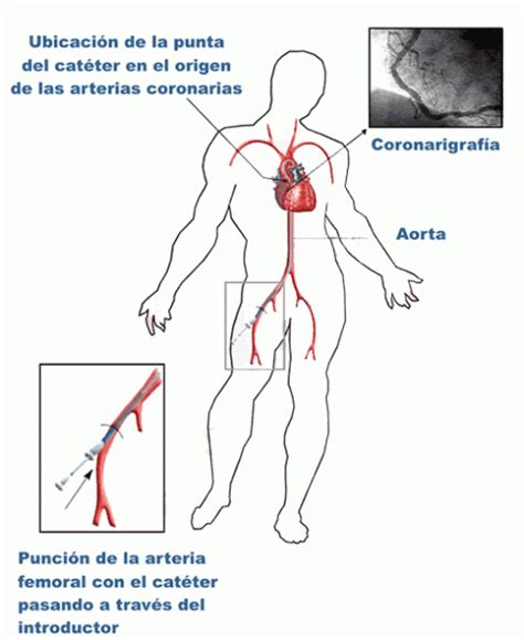 Cateterismo Cardíaco Arterias y Venas