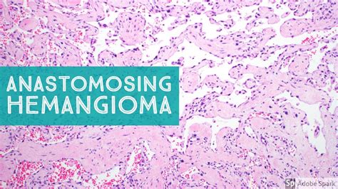 Anastomosing Hemangioma 101 Explained By A Soft Tissue Pathologist