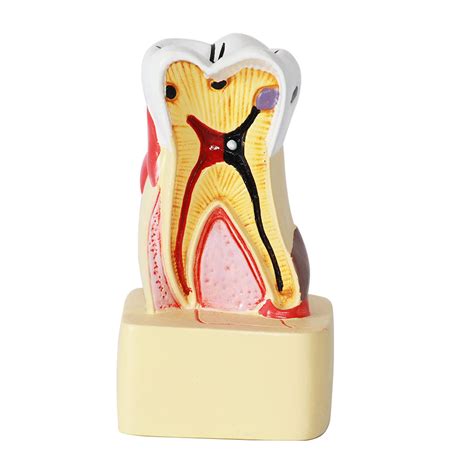 Buy Tooth Decay Model Times Caries Comparative Study Models Dental