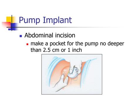 Ppt Intrathecal Baclofen For Spasticity Powerpoint Presentation Id