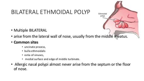 Nasal Polypi Otorhinolaryngology Types Etiology Management Ent Ppt