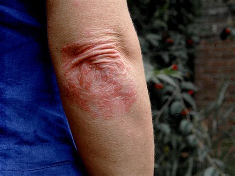 Psoriasis Vs Eczema Differences In Symptoms And Treatments