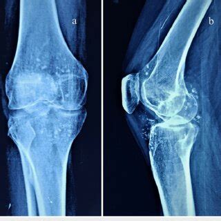 Radiograph Of The Left Knee In AP A And Lateral B Views With