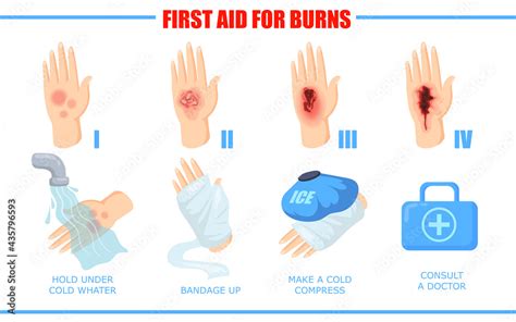 Ways Of Healing Different Skin Burn Injuries Cartoon Vector