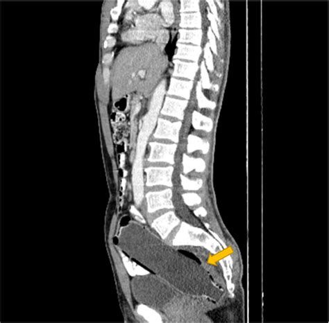 Rectal Foreign Body In Adult Male Unusual Case Report And Literature