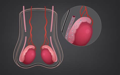 Process Of A Vasectomy