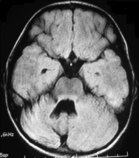 Axial FLAIR Brain MRI Scan Of Patient 1 The 15 Month Follow Up MRI