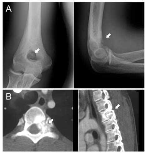 Osteoblastom Radiologie