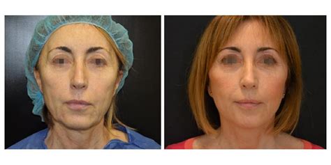 Chirurgie Visage Paris Prix Interventions Et Techniques