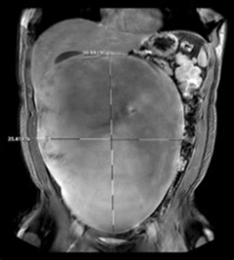 Mr Abdomen And Pelvis With Contrast Demonstrating 31 × 25 Cm