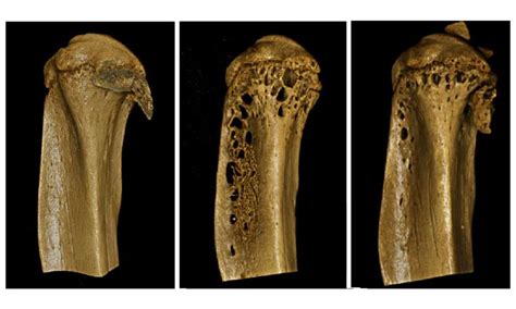 Promising new therapeutic approach for debilitating bone disease