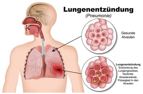 Lungenentzündung Was ist das Pneumonie Inhalation de