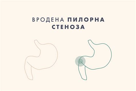 Вродена пилорна стеноза - какво представлява? | For Life