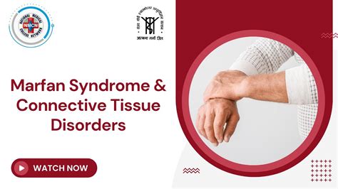 Marfan Syndrome Connective Tissue Disorders YouTube