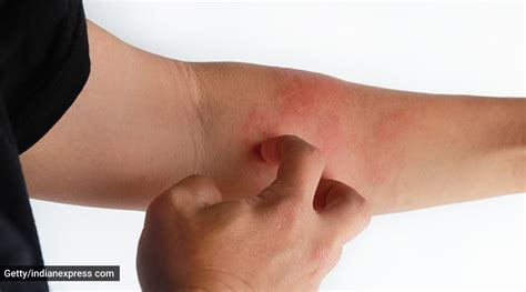 Atopic Dermatitis Know All About The ‘itch That Rashes Health News