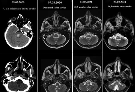 The Figure Showing The Temporal Course Of The Neuroimaging Findings Of