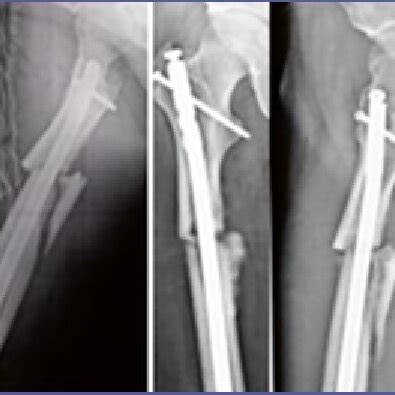 Healing Of Proximal Femoral Shaft Fracture Treated With Intremedullar