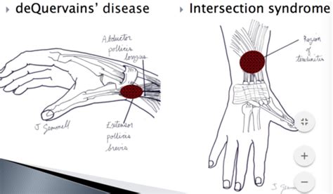 Ortho Rheum Wrist And Hand Flashcards Quizlet