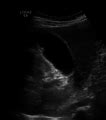 Category Ultrasound Images Of Gallbladder Polyps Wikimedia Commons