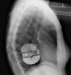 Emblem Mri S Icd System Why S Icd Therapy Boston Scientific