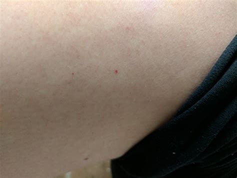 Pinpoint Red Spots On Skin Jerylan