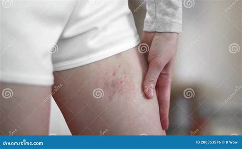 A Woman Was Bitten By An Insect On The Leg Close Up Consequences Of