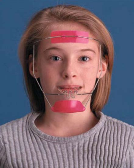 Orthodontic Headgear News Dentagama