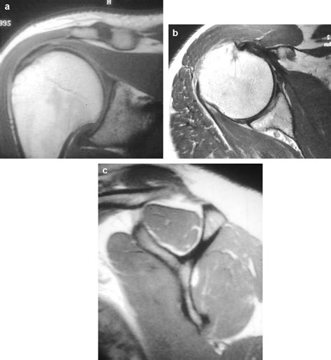 Figure 1 from Rotator cuff tear imaging in patients over 70 years ...