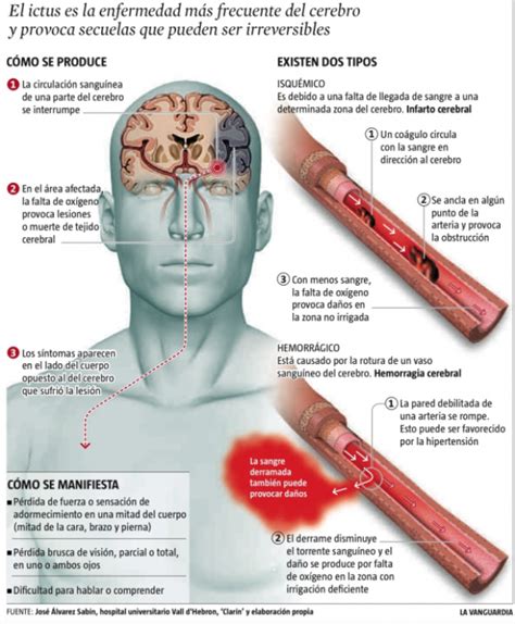 Accidente Cerebrovascular Qué Es Y Qué Mecanismos Lo Provocan