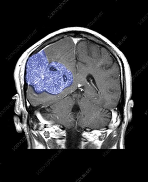 Brain Mri Tumor