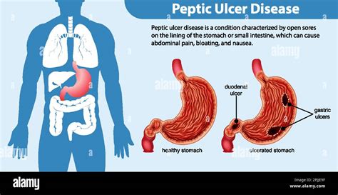 Peptic Ulcer Disease Infographic Illustration Stock Vector Image And Art Alamy