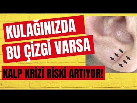 Kulak Memesindeki bu çizgiye dikkat Kalp Krizini artırıyor YouTube