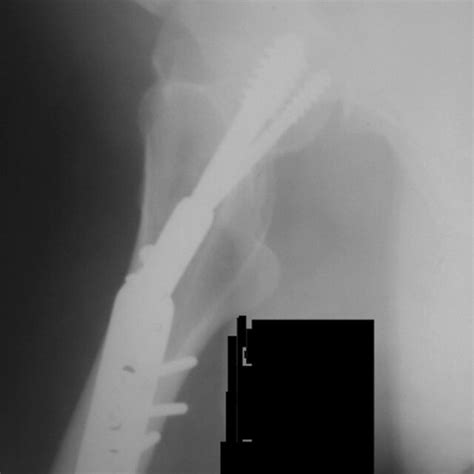 D And E Antero Posterior And Lateral Radiographs Were Made Two Months