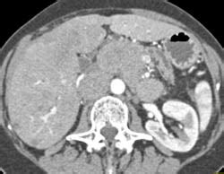 Pancreatic Cancer With Liver Metastases With Extensive Adenopathy