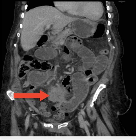 Figure 2 From Adenocarcinoma Of Mullerian Origin Presenting As Small