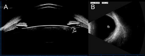 Ultrasound Biomicroscopy And Ocular B Scan Of The Patients Left Eye