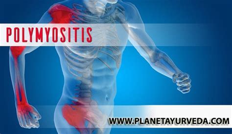 Polymyositis Causes Symptoms Diagnosis And Natural Treatment