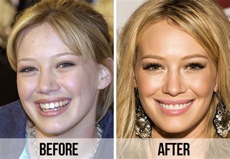 Celebrities Teeth with Veneers Before&After