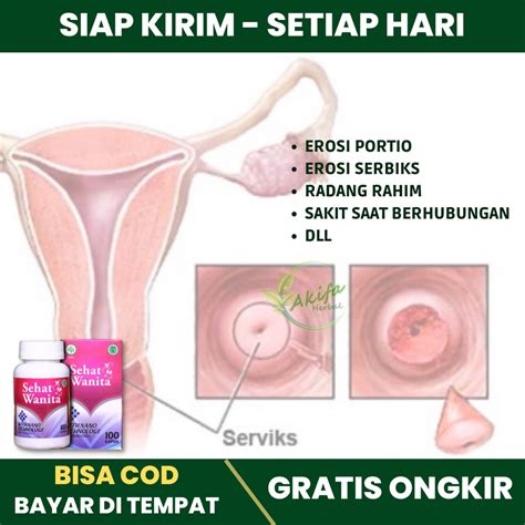 Jual Obat Erosi Portio Serviks Erosi Leher Rahim Ektropion Serviks