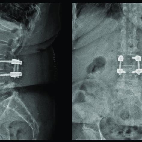 Postoperative Radiographs Download Scientific Diagram