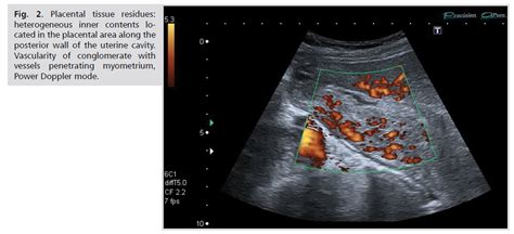 Ultrasound Monitoring Of Uterine Involution In The Postpartum Period