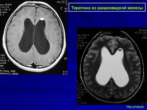 ГМ. Шишковидная железа (патология). + | Портал радиологов