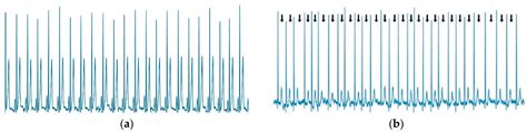 Sensors Free Full Text Short Single Lead Ecg Signal Delineation Based Deep Learning