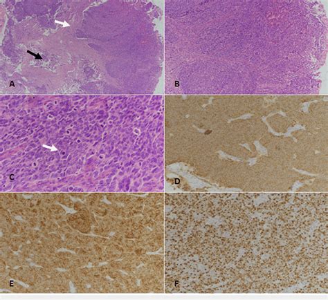 Poorly Differentiated Neuroendocrine Carcinoma Pdnec A Download Scientific Diagram