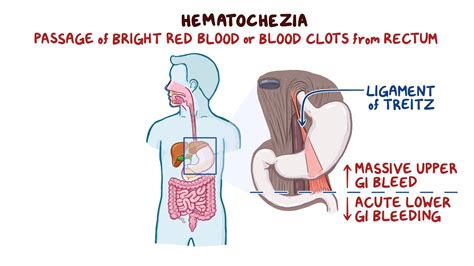 Hematochezia: What Is It, Causes, Signs, Symptoms, And More, 50% OFF