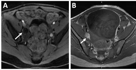 Paraneoplastic Neurological Syndromes A Practical Approach To Diagnosis And Management