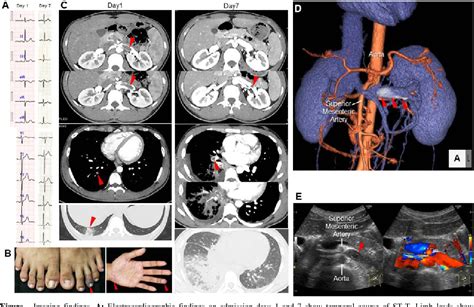 Figure I From Acute Pulmonary Thromboembolism In A Patient With